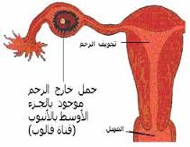 اعراض الحمل خارج الرحم