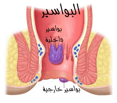 ماهي البواسير