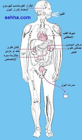 علاج نقص الصوديوم في الجسم 20160820 3854 1