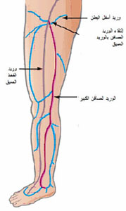 دوالي الفخذين