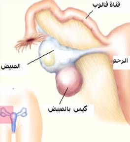 كيس على المبيض الايمن