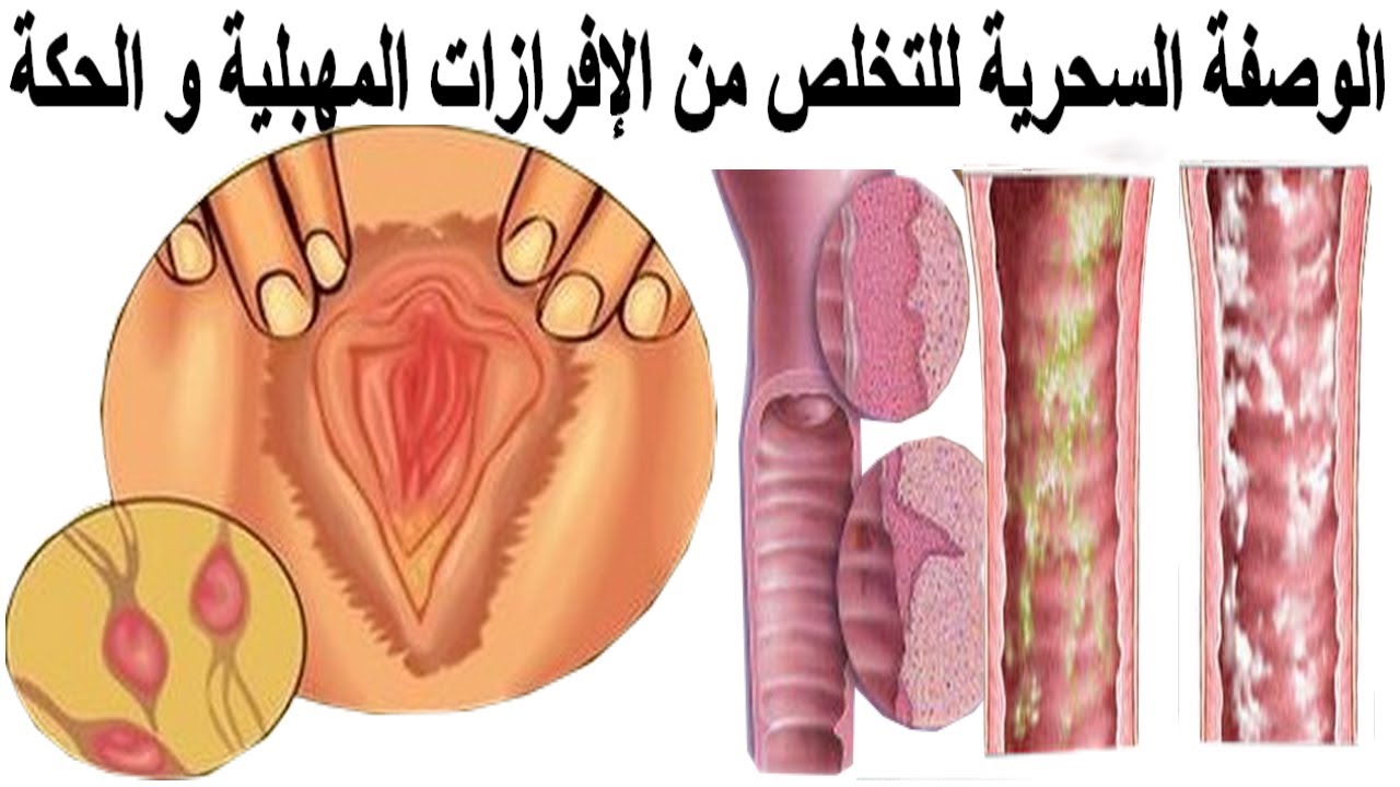 علاج الحكة الخارجية للمهبل