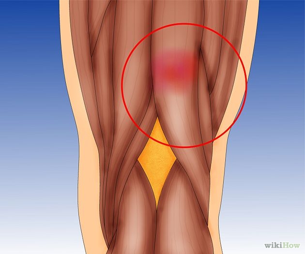 علاج تمزق العضلات بالاعشاب