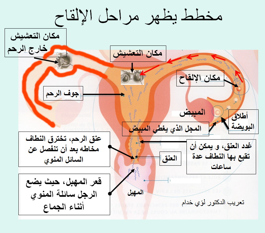 بالصور علاج ضيق عنق الرحم