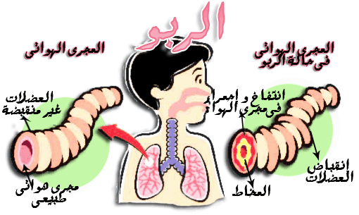 علاج الربو في الطب النبوي