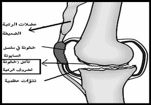 خشونة الركبة بالصور