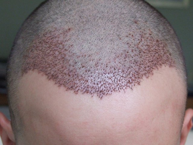 افضل عيادات زراعة الشعر في تركيا