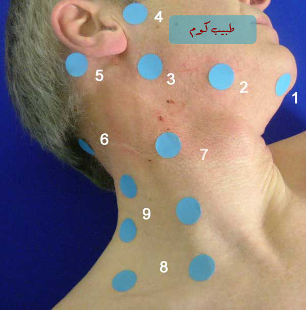 بالصور غدة لمفاوية منتفخة في الرقبة