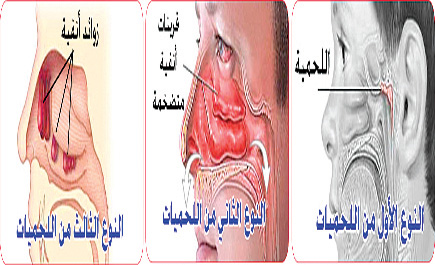 علاج اللحمية عند الاطفال 20160820 5619 1