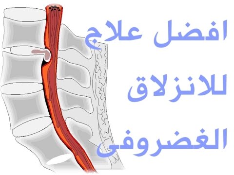 علاج الغضروف الظهر بالاعشاب 20160818 4031 1