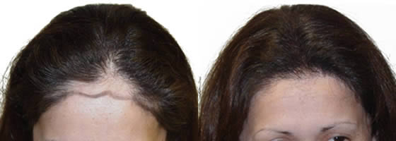 تجارب زراعة الشعر للنساء