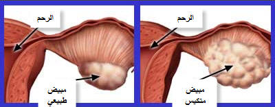 بالصور علاج التكيس بالاعشاب