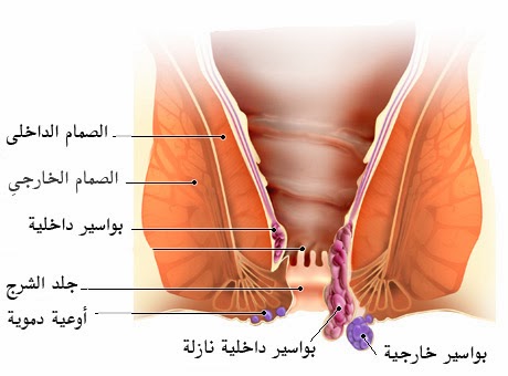 مرض البواسر