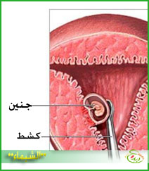 عملية الكحت والتنظيف بعد الاجهاض