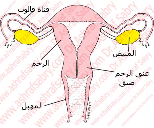 علاج ضيق عنق الرحم