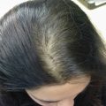 بالصور علاج تساقط شعر مقدمة الراس