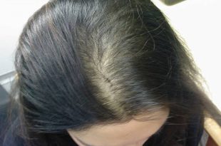 بالصور علاج تساقط شعر مقدمة الراس