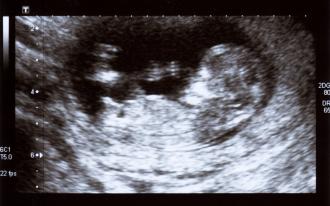 بالصور اعراض اول اسبوع حمل