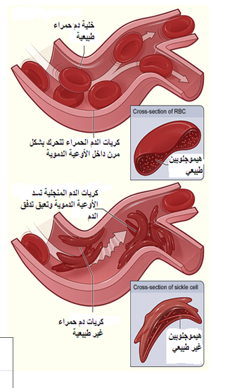 الانيميا المنجلية وعلاجها